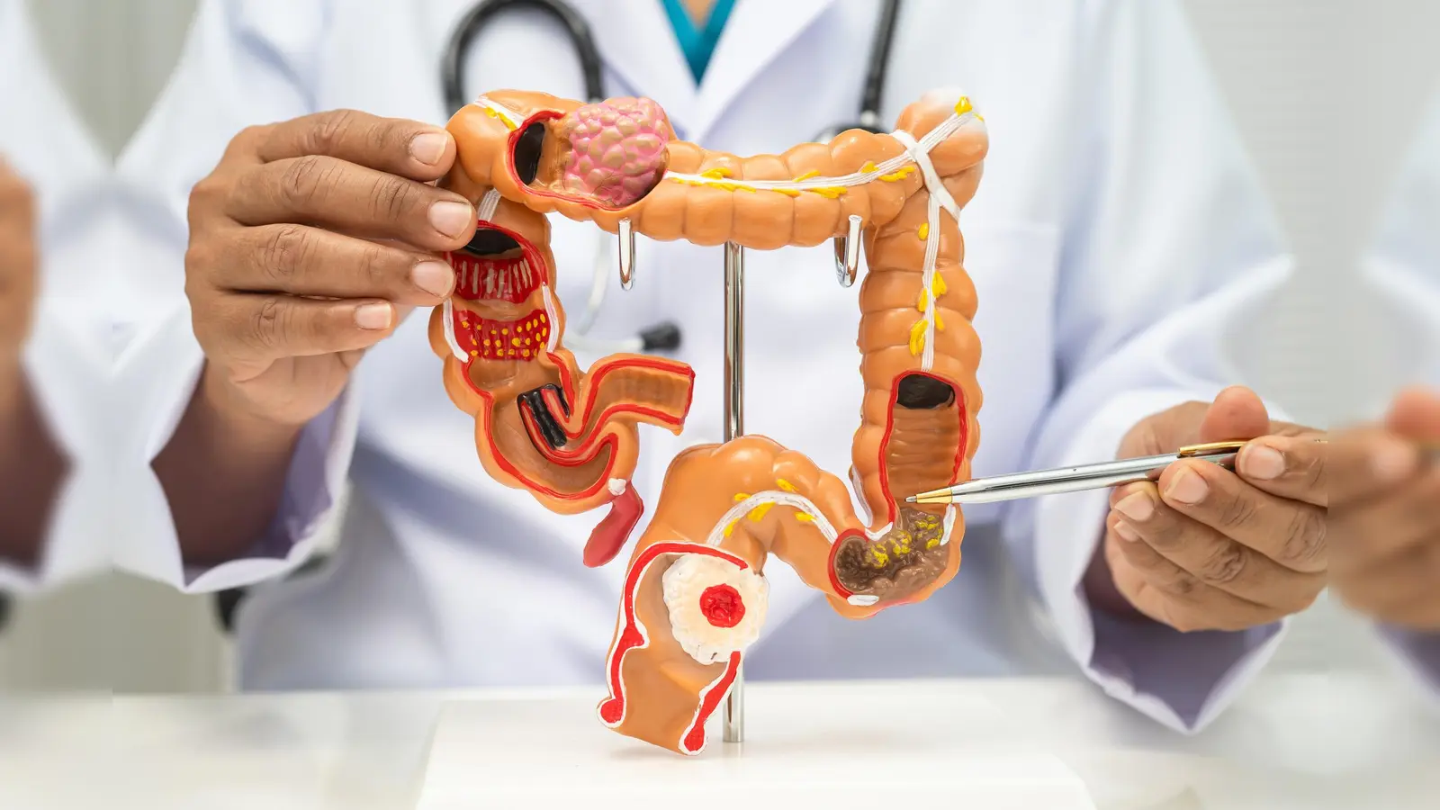 Darmkrebs ist gut behandelbar. (Bild: iStock/Warawan Tongsri)